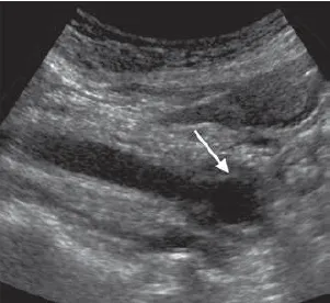 Choledochal cyst Type III