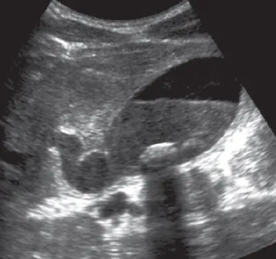 Acute cholecystitis signs