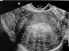 Adenomyosis