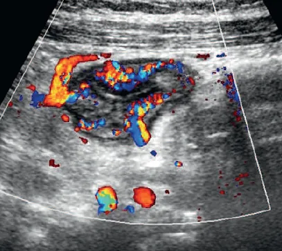 Ulcerative Colitis