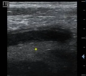 Periappendiceal fat inflammation in appendicitis