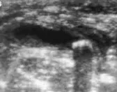 Appendicolith with acoustic shadow