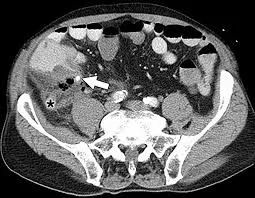Appendicolith on CT scan