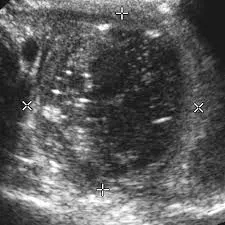 Appendiceal abscess fluid collection