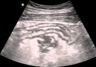 Perforated appendicitis ultrasound