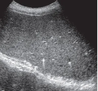Biliary Hamartoma