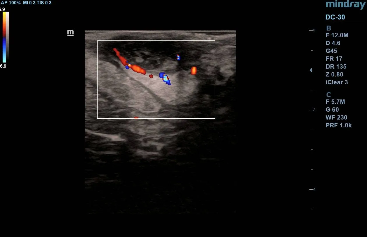 Color Doppler ultrasound demonstrating significant peripheral vascularity surrounding the hypoechoic breast abscess.