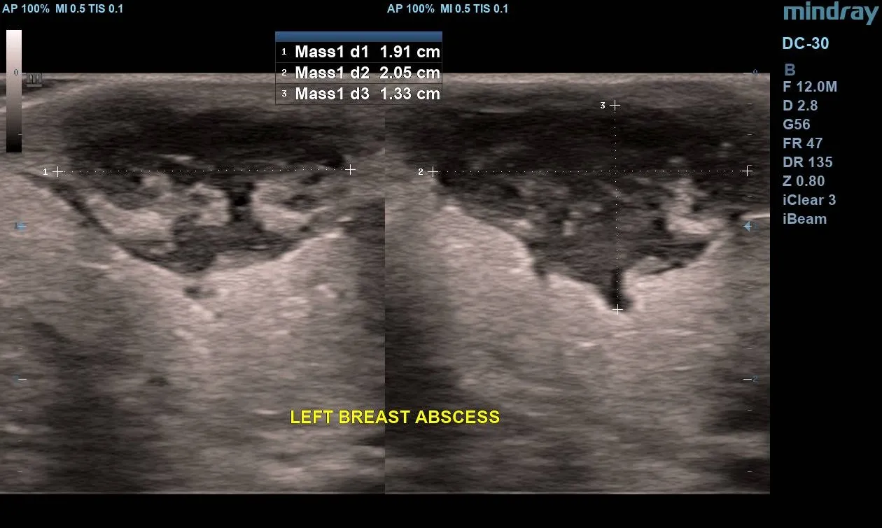 Ultrasound image showing the multi-planar measurements of the breast abscess and prominent posterior acoustic enhancement.