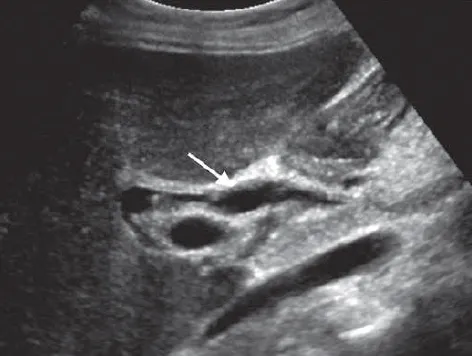 Cholangitis ductal thickening