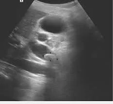 CBD dilation with choledocholithiasis