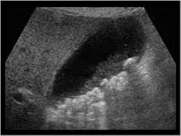 Cholelithiasis