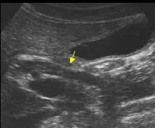 Cholangitis with debris