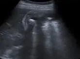 Cholangitis with stone