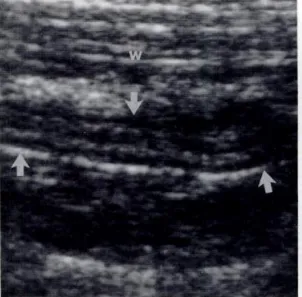 Chronic appendicitis ultrasound