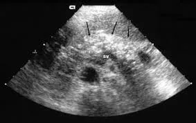 Chronic pancreatitis ultrasound with calcifications
