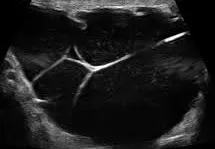 Complex hydrocele