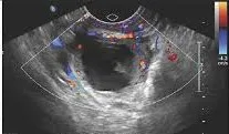 Ring of fire sign ultrasound