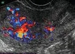 Endometrial cancer