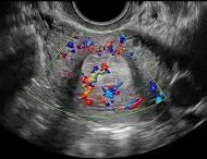Endometrial polyp