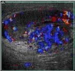 Epididymo-orchitis