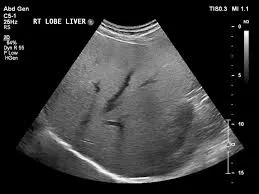 Grade 2 Fatty liver