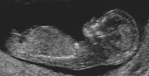 Female Sagittal Sign (Nub Theory)