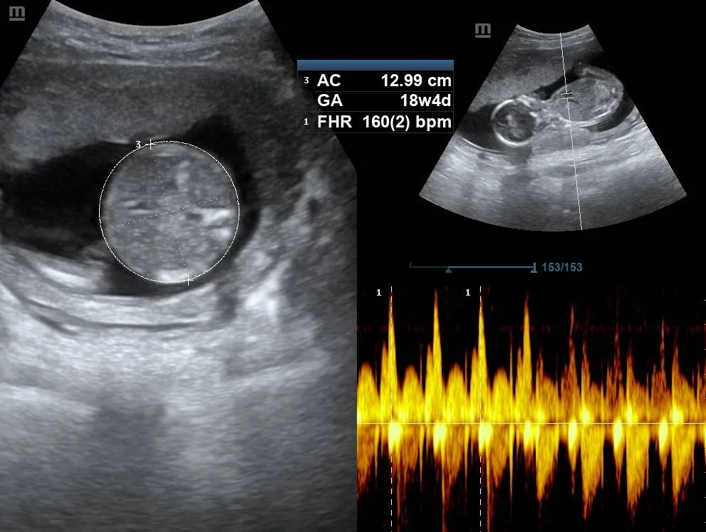 Fetal ultrasound showing normal abdominal circumference (AC) at 18w4d and heart rate of 160 bpm.