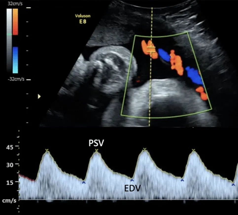 Normal Umbilical artery Doppler