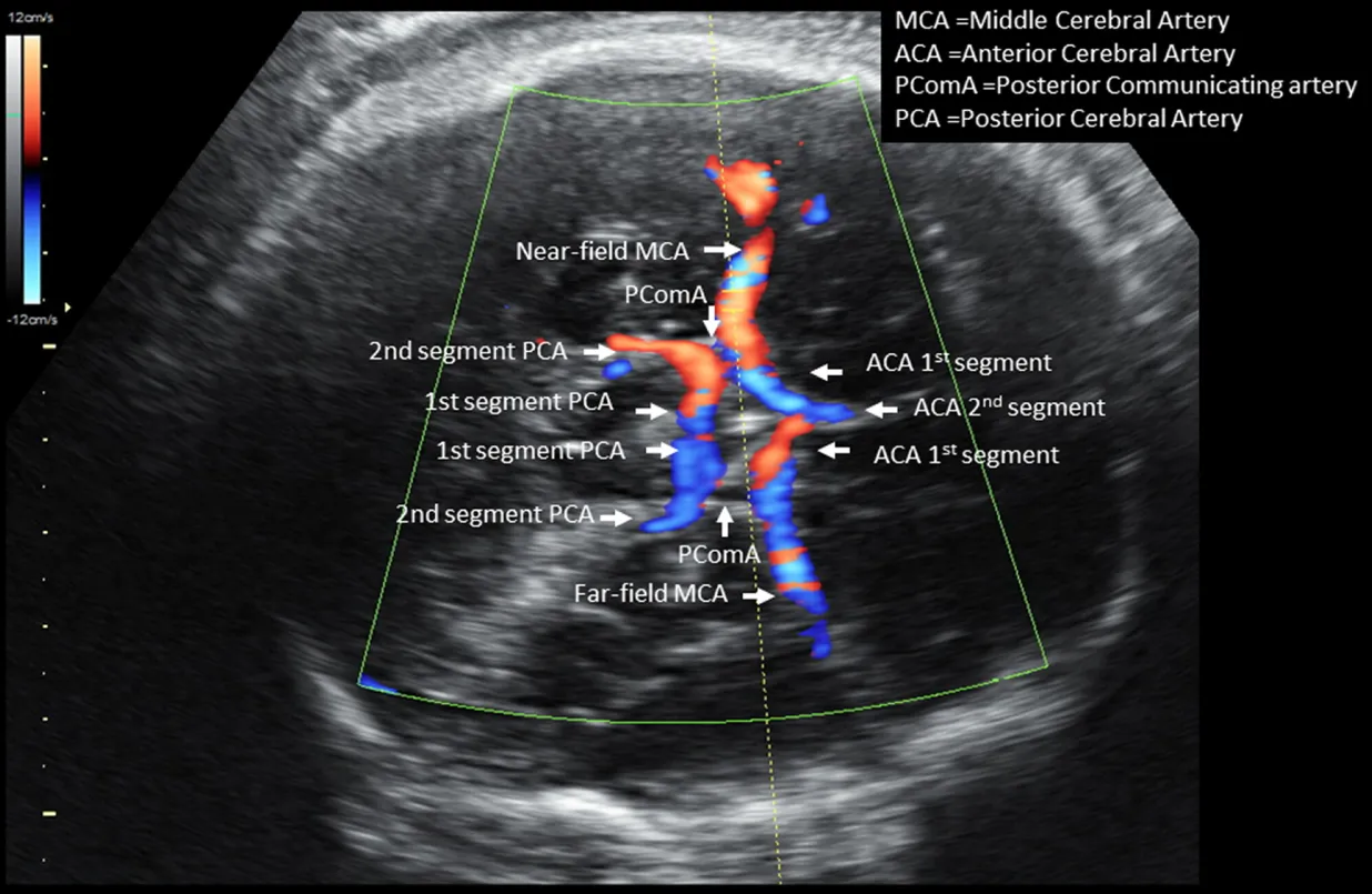 A color Doppler fetal brain ultrasound mapping the circle of Willis