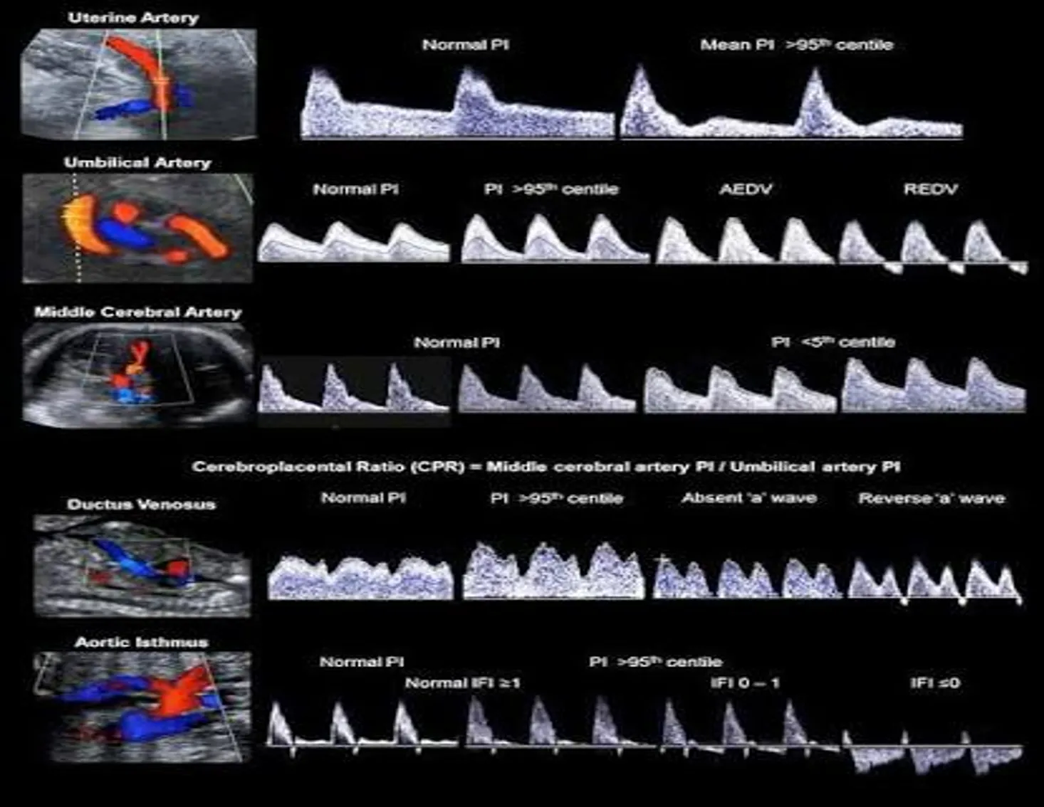 A comprehensive multi-panel medical chart showing color Doppler ultrasound scans on the left matched with corresponding spectral Doppler waveforms on the right.