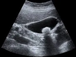 Cholelithiasis