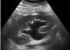 Hydronephrosis