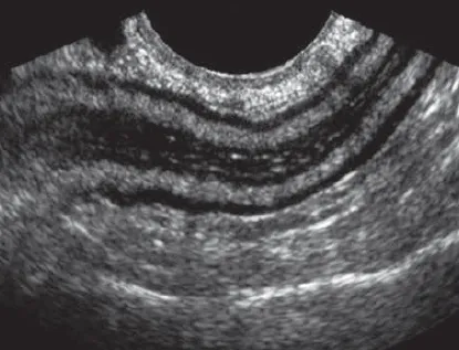Normal bowel wall gut signature layers