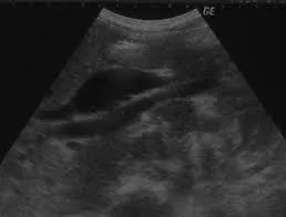HIV cholangiopathy papillary stenosis