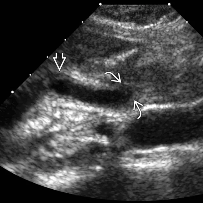 HIV cholangiopathy strictures