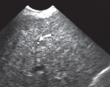 Echogenic pattern after therapy