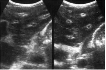Periportal fibrosis