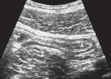 Normal appendix longitudinal ultrasound view