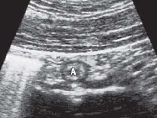 Normal appendix transverse ultrasound view