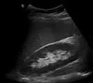 Normal kidney