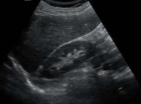 Normal Liver