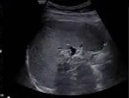 Normal Spleen