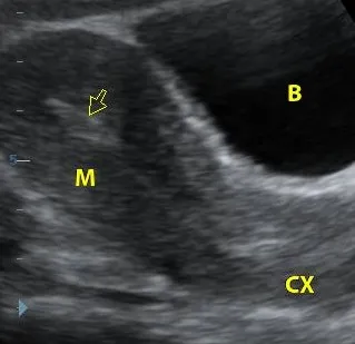 Normal uterus sagittal