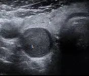 Parathyroid adenoma