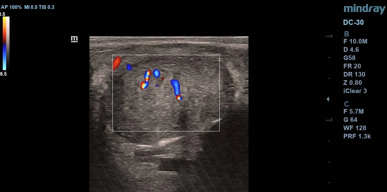 Color Doppler ultrasound demonstrating internal vascularity within the parotid pleomorphic adenoma.