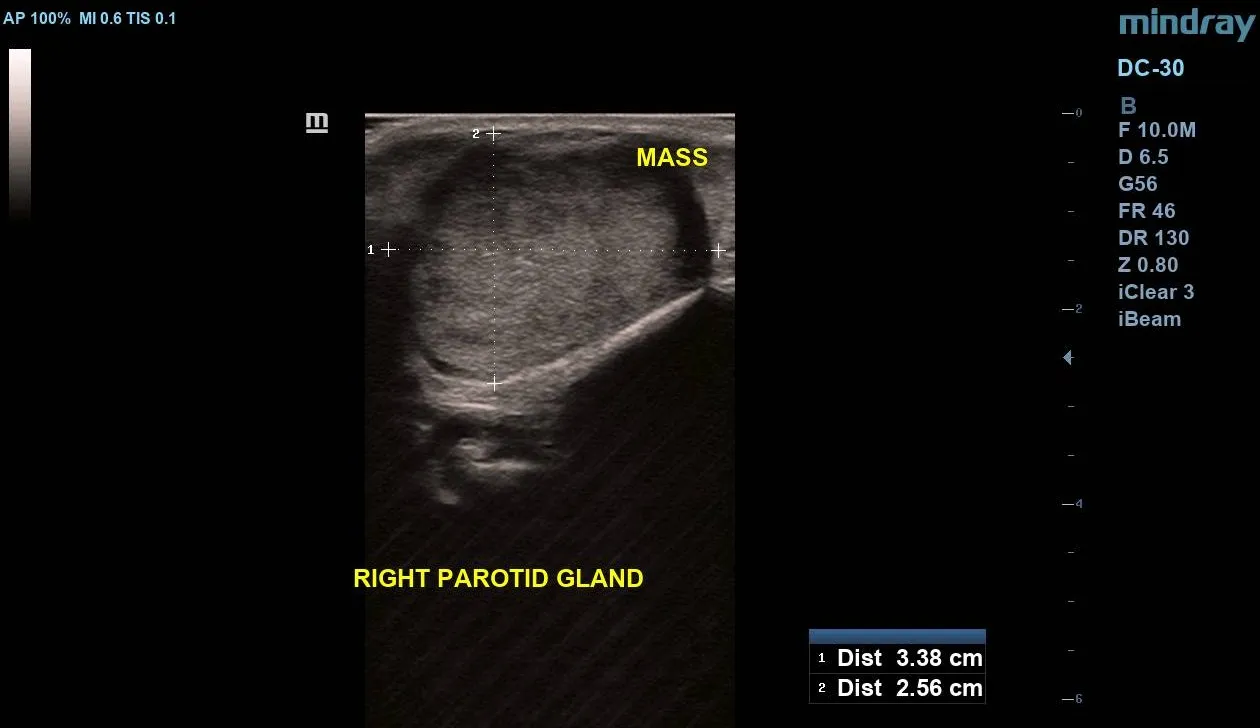 Ultrasound image showing multi-planar measurements of the parotid mass, measuring approximately 3.38 cm x 2.56 cm.
