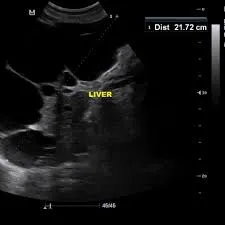 Advanced polycystic liver disease ultrasound