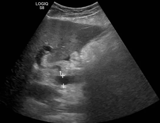 B-Mode ultrasound showing main portal vein diameter of 15.1 millimeters