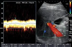 Doppler ultrasound showing hepatofugal flow in the portal vein