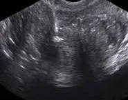 Prostate calcifications